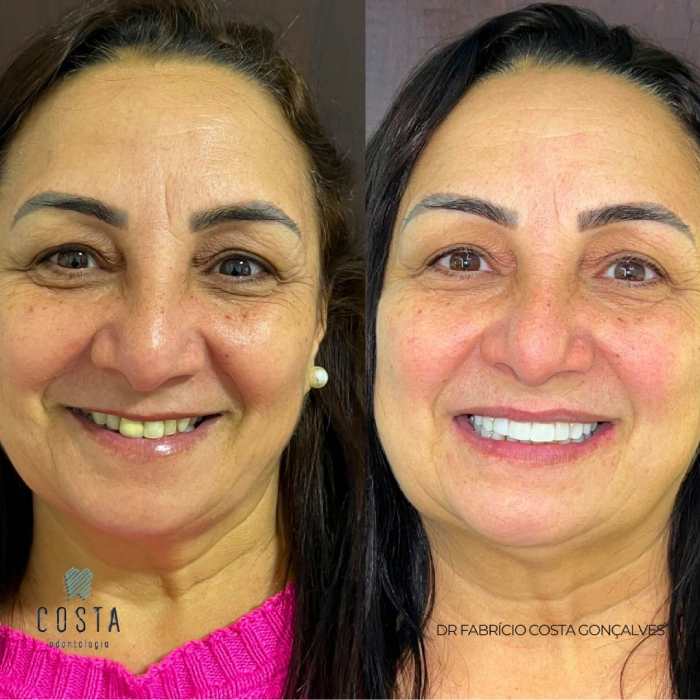 Implantes dentários em Franca SP