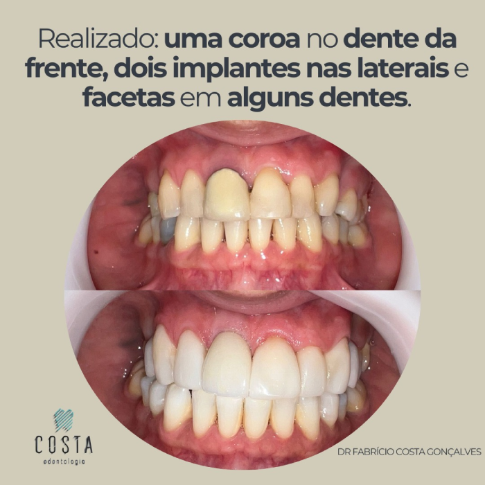 Implantes dentários em Franca SP